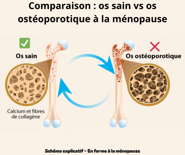 Schéma comparatif montrant la différence entre os sain et un os ostéoporotique après la ménopause